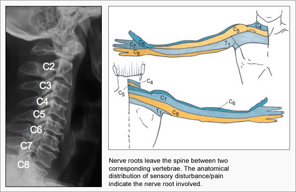 Cervical Radicular Pain E Algos