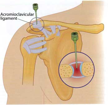 Steroid injection area