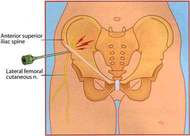 Steroid injection knee landmarks