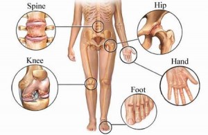 A csípőízület ízületi gyulladása 2 fok Az ízületi só kezelése - 1 2 csípőízület osteoarthritis